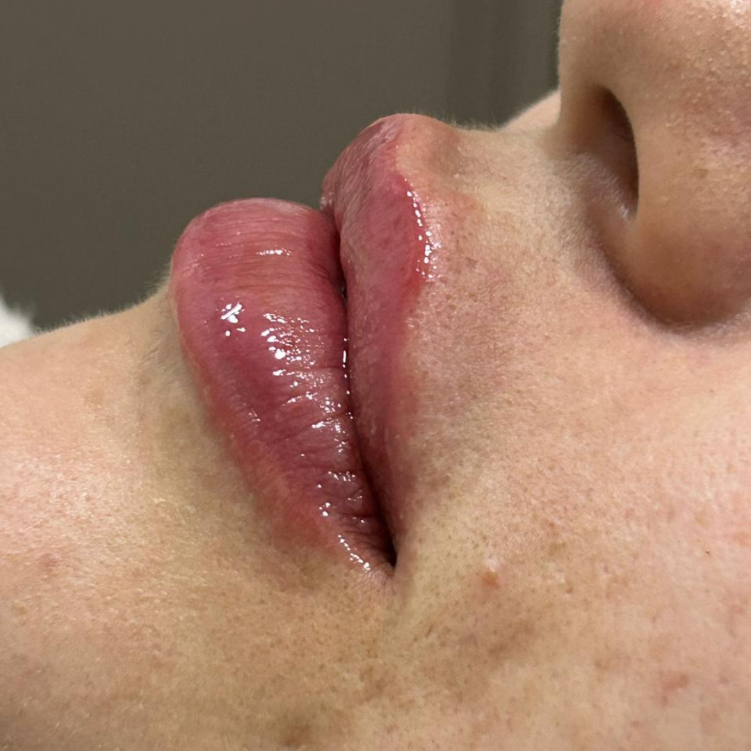 Preenchimento Labial